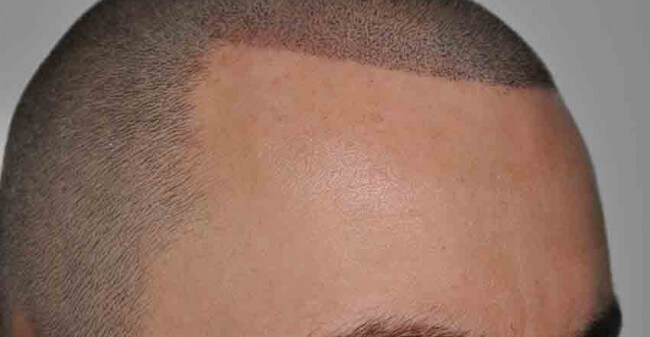 Scalppigmentation