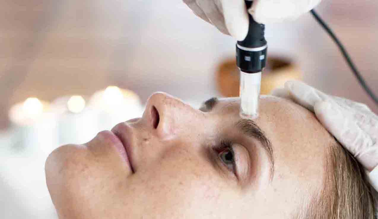 Een mooiere huid met microneedling