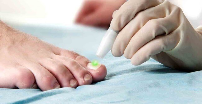 Schimmelnagels? Laat ze laseren!