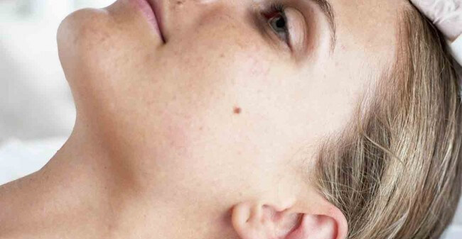 Microneedling