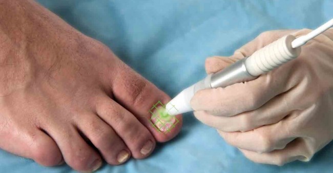 Snel en veilig van je schimmelnagels af?