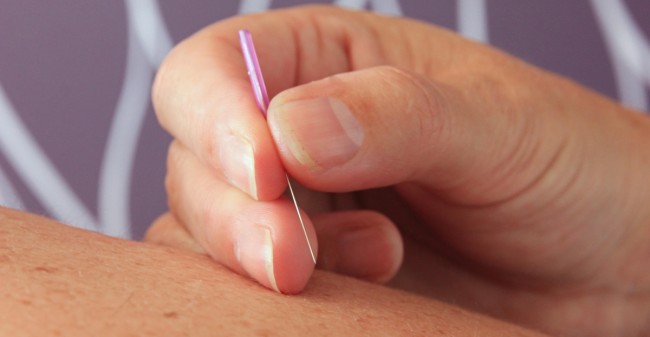 Afvallen met acupunctuur