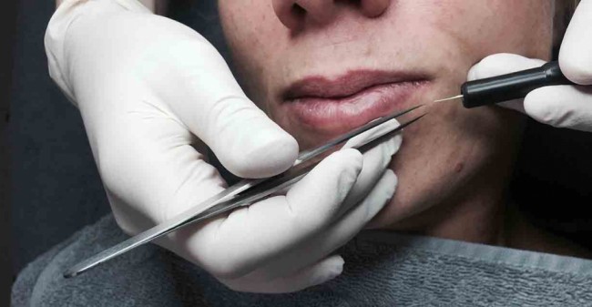 Weg met die overbeharing of acne!