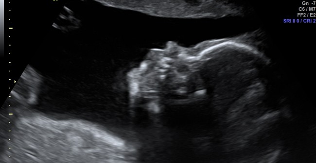 Ontmoet je baby met een pretecho!