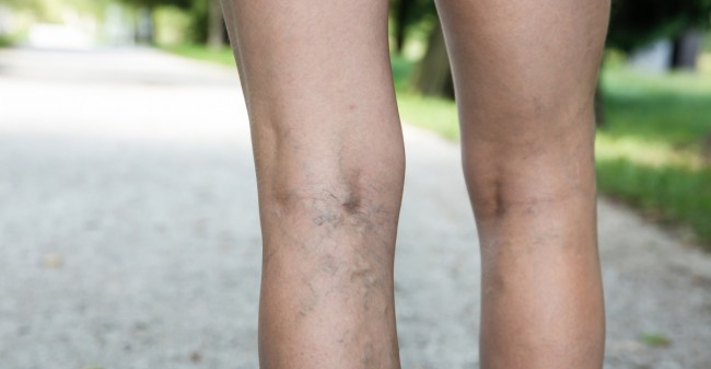 Vaatchirurgie helpt bij grote spataderen