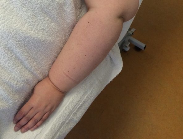 Blijf niet rondlopen met oedeem