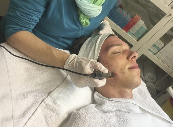 Acne: een kwaal bij jong & oud