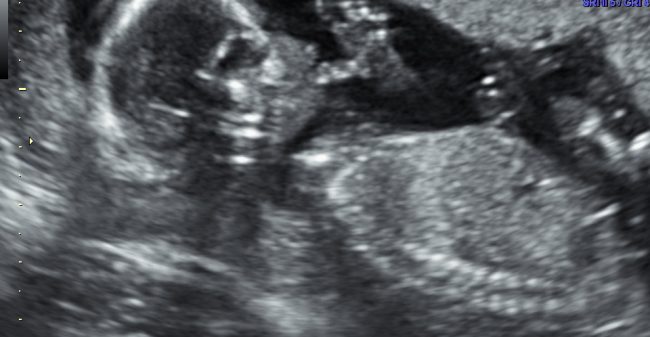 Kijken naar de baby in je buik