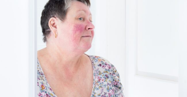 Rosacea: goed te behandelen
