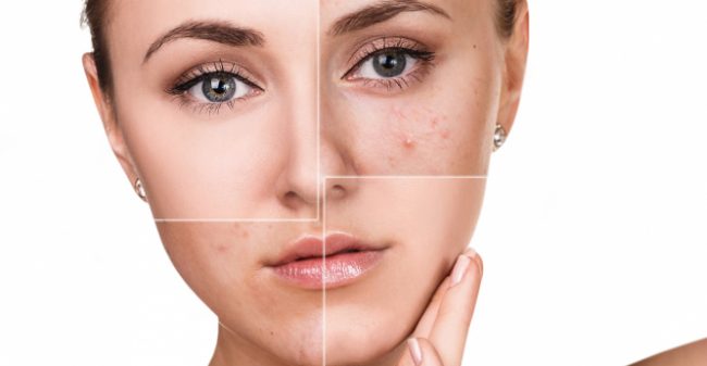 Acne:  wat kun je eraan doen?