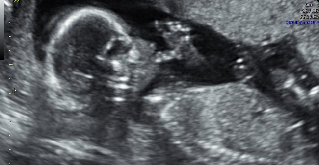 Kijken naar de baby in je buik