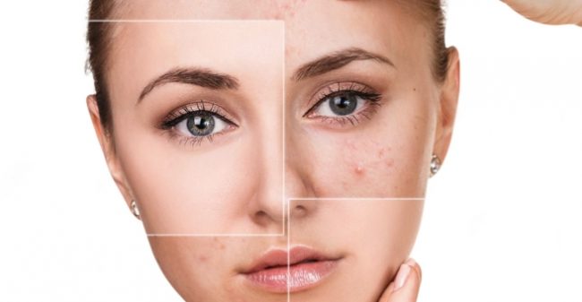 Acne: goed te behandelen