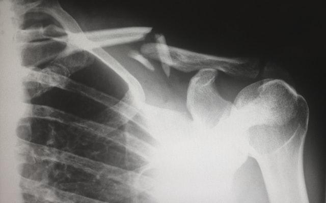 Nieuw algoritme dat artrose beter in beeld kan brengen