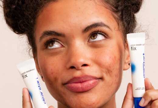 O jee, acne!