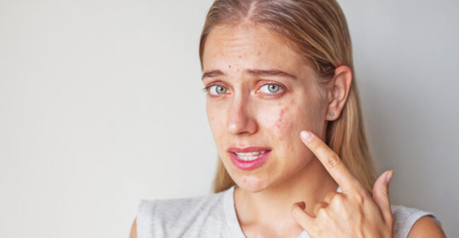 Acne: wat is het en wat kun je eraan doen?